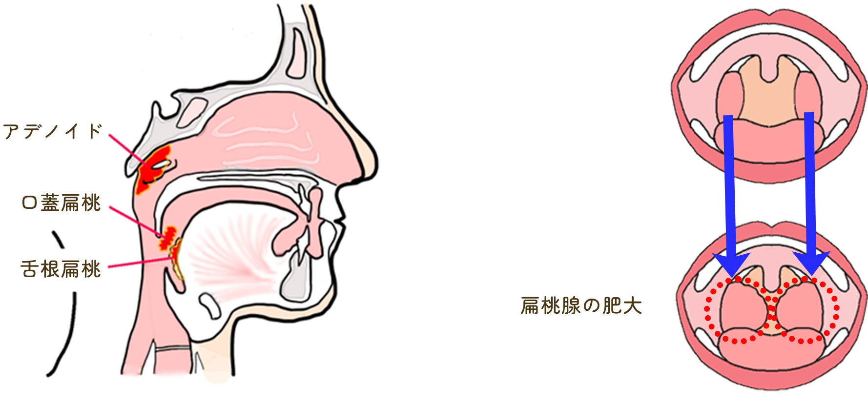 扁桃炎繰り返す 原因, 扁桃炎 ぶり返し 理由 – BDMC
